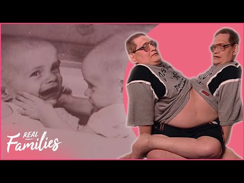 Nurture: Uniquely United - The Galyon Conjoined Twins |Real Families